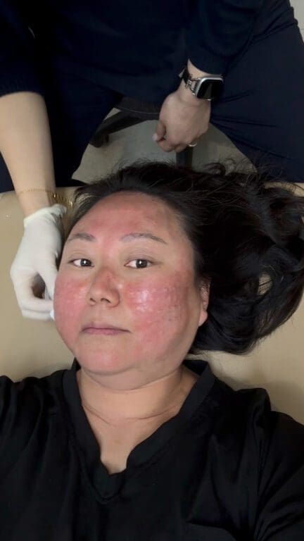 skin treatments in seoul | rejuran injections