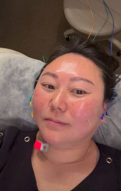 acupuncture for facial asymmetry at duna clinic in seoul
