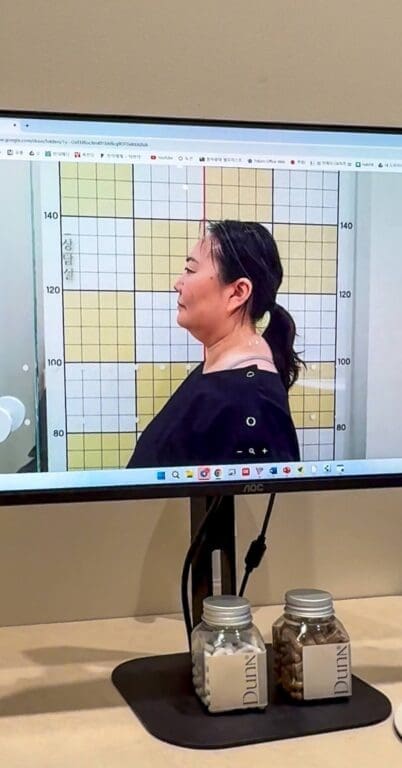 picture of tech neck and buffalo hump at duna clinic in seoul