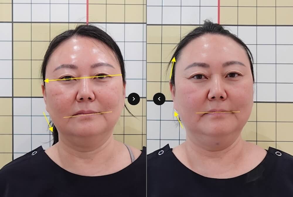 Before and after facial asymmetry treatments at Duna Clinic in Seoul.