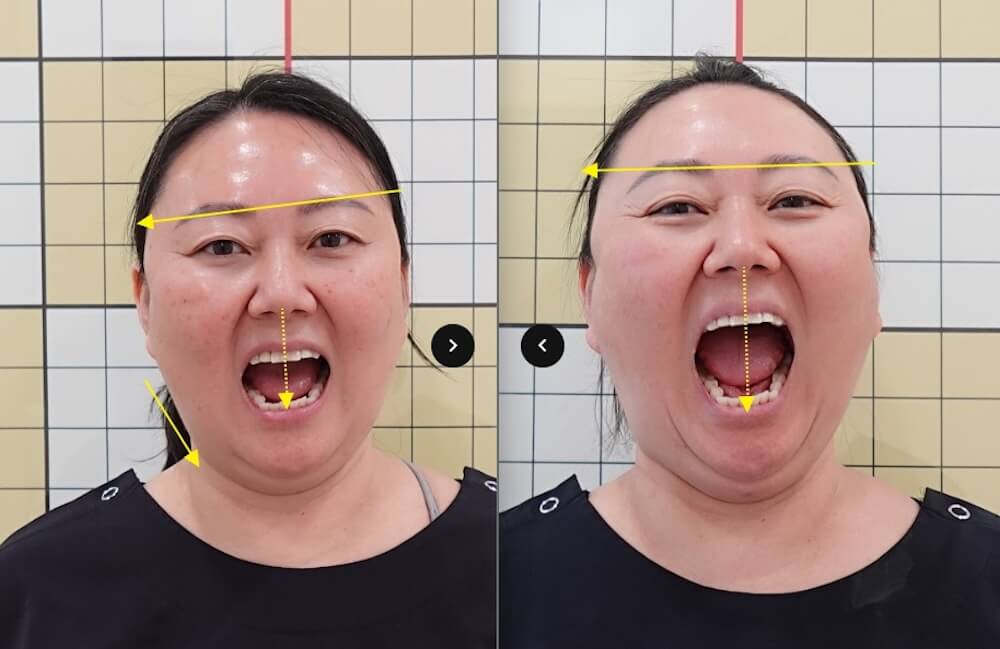 before and after results from facial asymmetry treatments at duna clinic in seoul