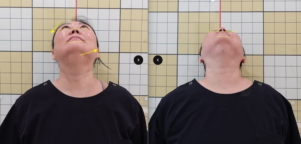 before and after images from facial asymmetry treatment at duna clinic in seoul