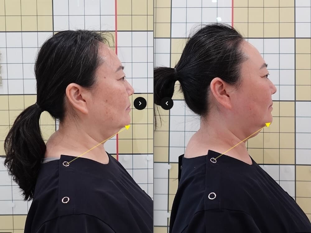 results of buffalo hump treatment at duna clinic in seoul korea