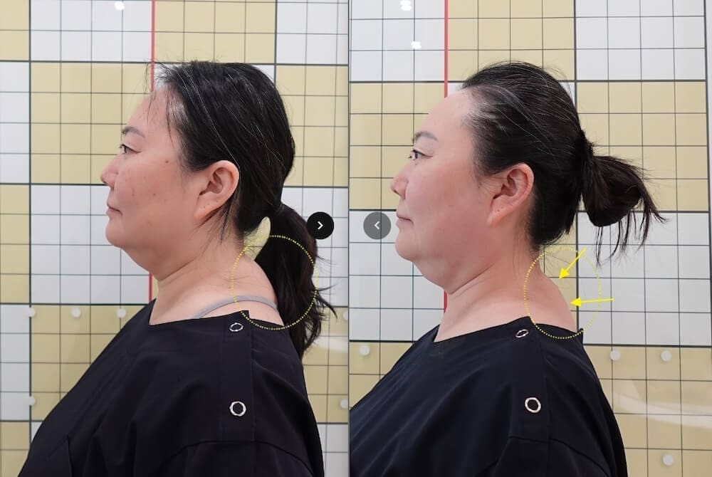 before and after images from buffalo hump treatment at duna clinic in seoul korea
